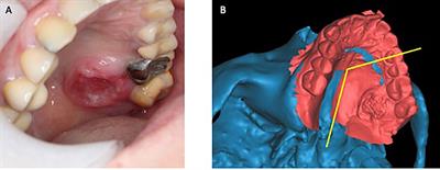 Unexpected Change of Surgical Plans and Contingency Strategies in Computer-Assisted Free Flap Jaw Reconstruction: Lessons Learned From 98 Consecutive Cases